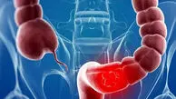 شش غذای روزمره که خطر سرطان روده را در زنان افزایش می‌دهند