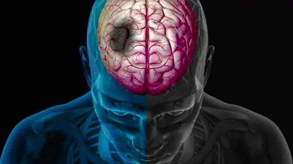 آیا این واکسن ساده می‌تواند شما را از سکته قلبی و مغزی نجات دهد؟