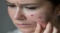 چای شیرین و شکلات جوش می‌آورند؟ / مواد غذایی پرقند و پرچرب که پوست را گل‌گلابی می‌کنند