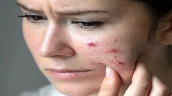 چای شیرین و شکلات جوش می‌آورند؟ / مواد غذایی پرقند و پرچرب که پوست را گل‌گلابی می‌کنند