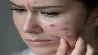 چای شیرین و شکلات جوش می‌آورند؟ / مواد غذایی پرقند و پرچرب که پوست را گل‌گلابی می‌کنند