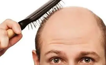 افشای راز رهایی از طاسی شغلی؛ گیاهی باستانی برای درمان «آلوپسی» 