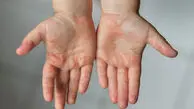هشدار جدی درباره گسترش سرخک در این استان