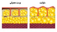 رازهای کمتر گفته‌شده برای رهایی از سلولیت و داشتن پوستی هموارتر