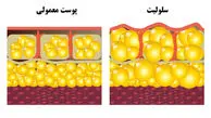 رازهای کمتر گفته‌شده برای رهایی از سلولیت و داشتن پوستی هموارتر