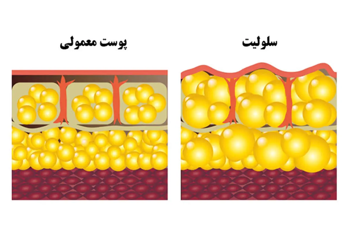 رازهای کمتر گفته‌شده برای رهایی از سلولیت و داشتن پوستی هموارتر