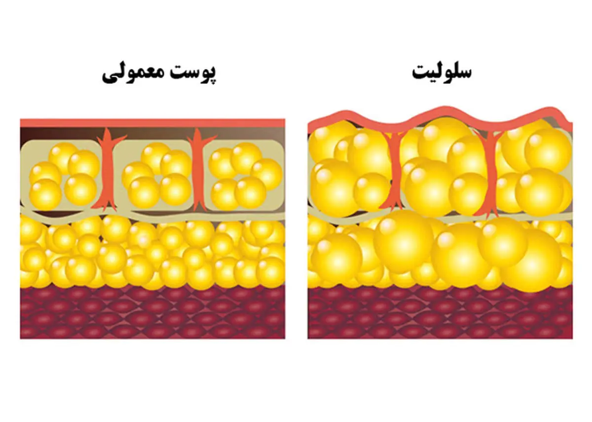 رازهای کمتر گفته‌شده برای رهایی از سلولیت و داشتن پوستی هموارتر